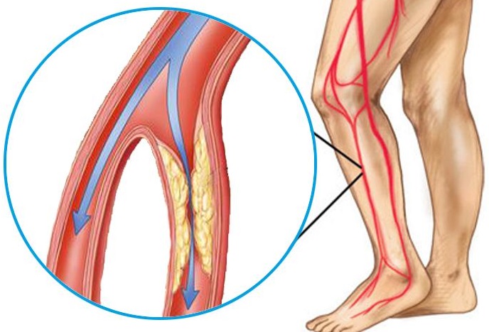 Arterele blocate pot duce la aparitia durerii in picior atunci cand mergi | gandlicitat.ro
