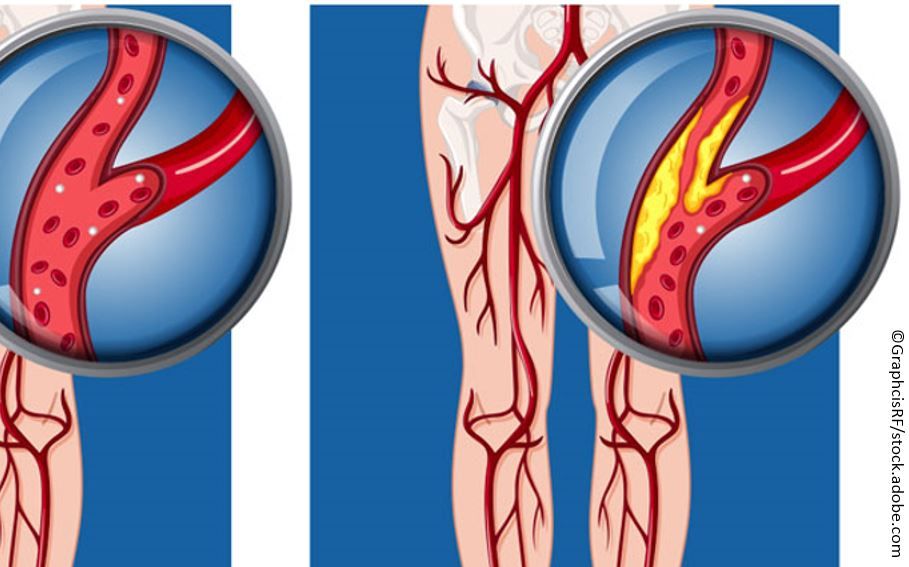 arteriopatie obliterantă stare subfebrilă și dureri articulare