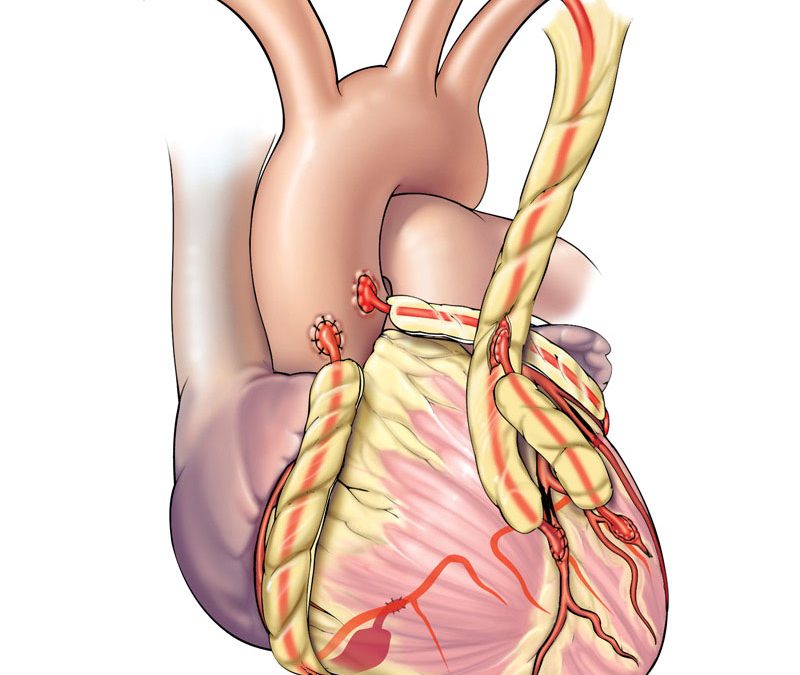 Viața cu bypass aortocoronarian: ce reguli trebuie să respecte pacientul?