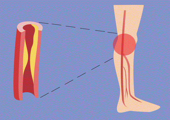 Arteriopatia obliterantă cronică a membrelor inferioare