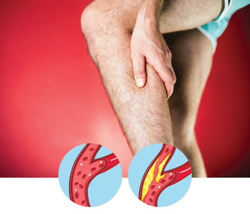 artroza gradului 3 al articulației genunchiului cauzează dureri articulare ca la temperatură
