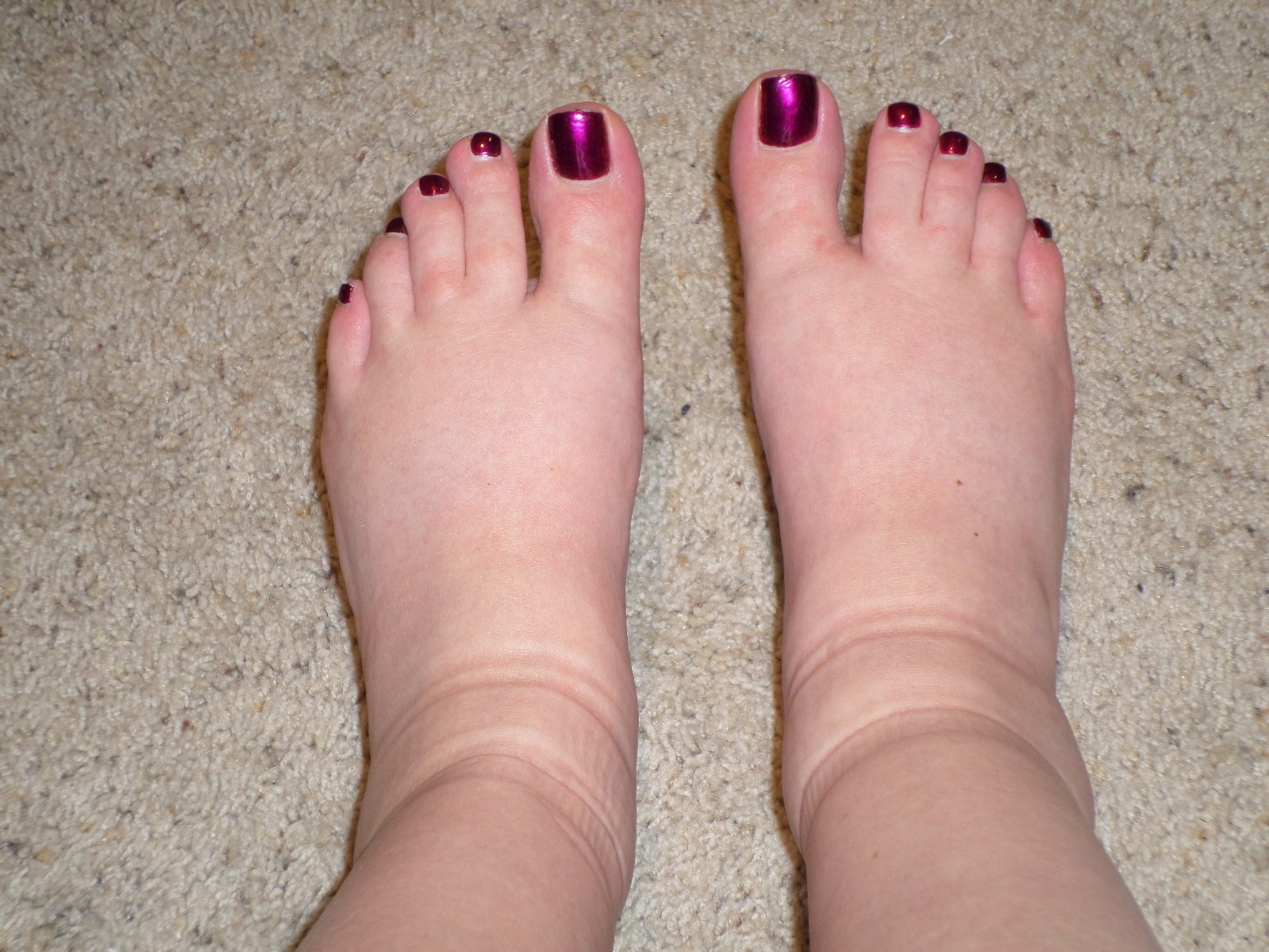 cauze umflare picioare artroza deget mare picior