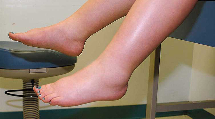 Picioare umflarea în glezne și dureri: o revizuire completă a cauzelor, tratament