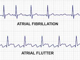 Fibrilația atrială: simptome cardiace, diagnostic și tratament Afib - Sănătate - 