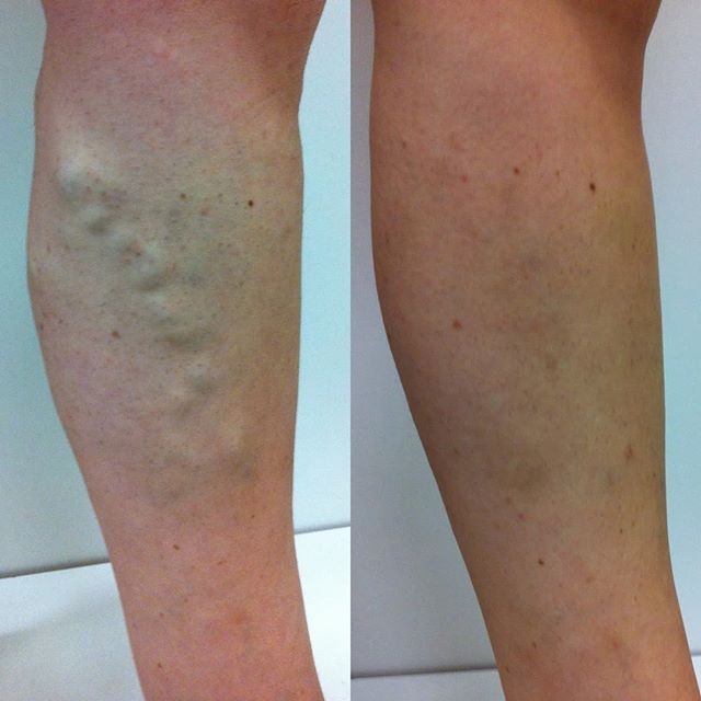 Dureri de picior sub genunchi în spate cu vene varicoase ,ulcere cronice varicoase